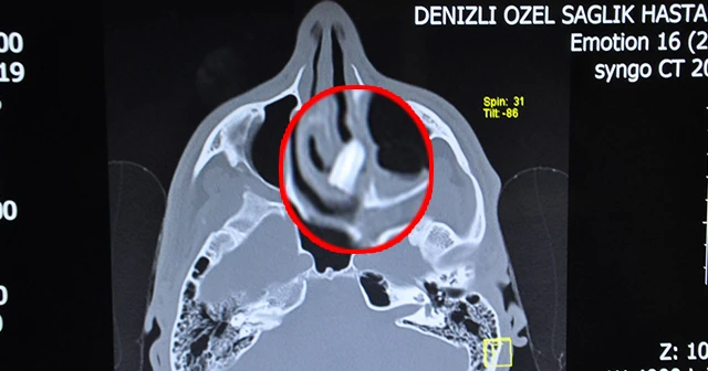 Burnundaki diş kökü 6 yıl sonra çıkarıldı